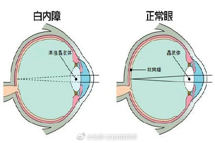 白内障常见的主要症状是什么 ？